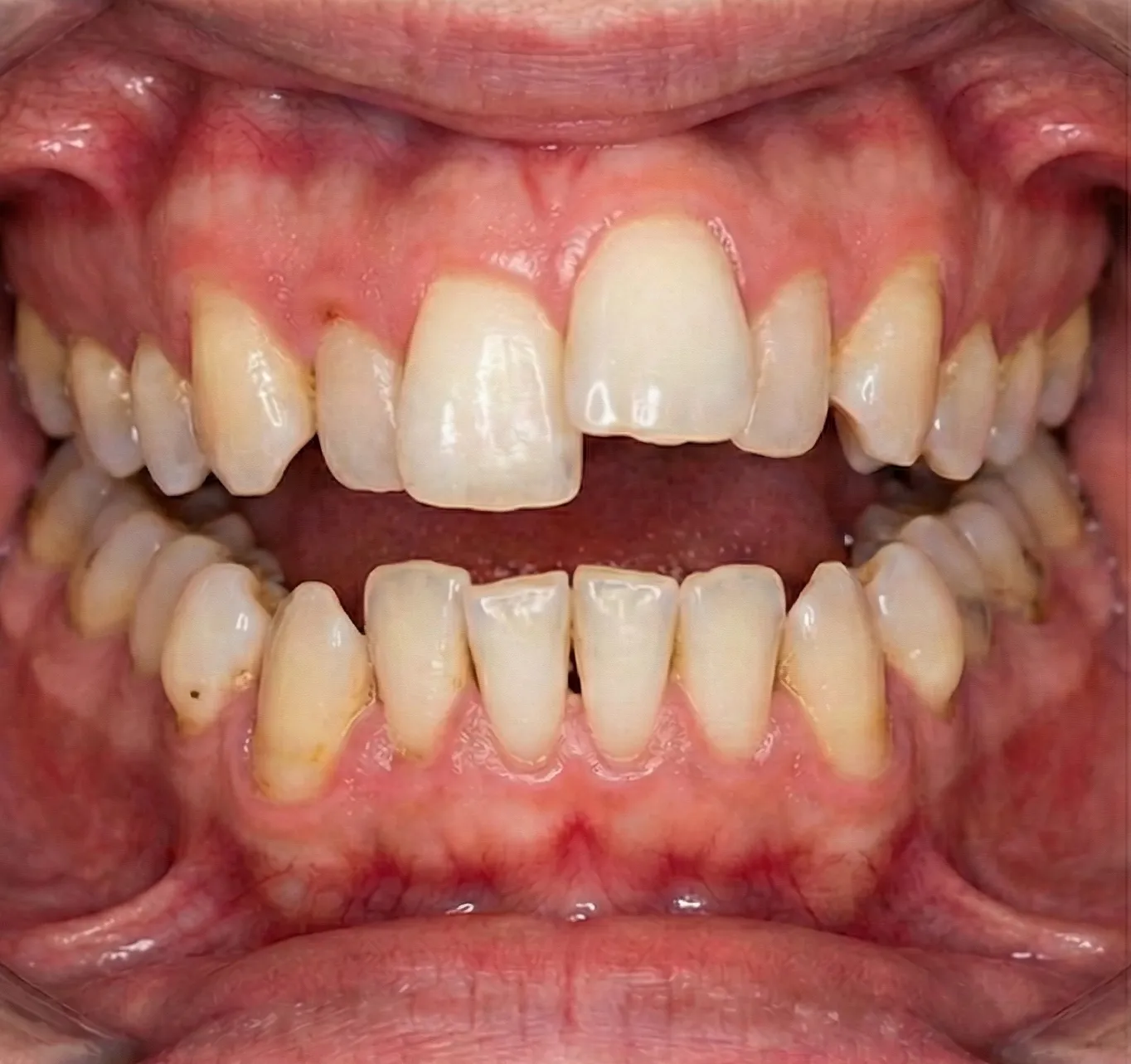 Tänder före Invisalign-behandling hos Gislaved Tandklinik